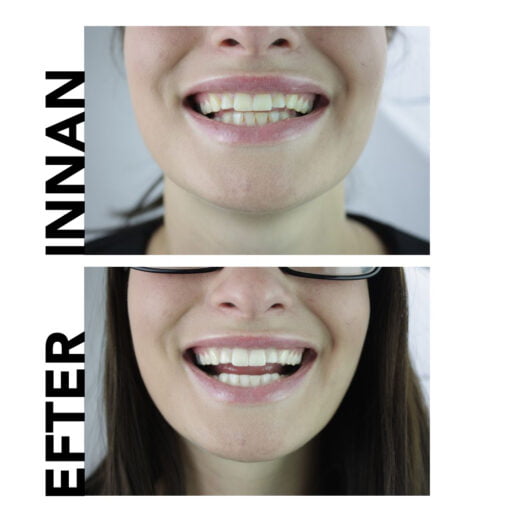 naturliga tänder vitare tandkräm före och efter